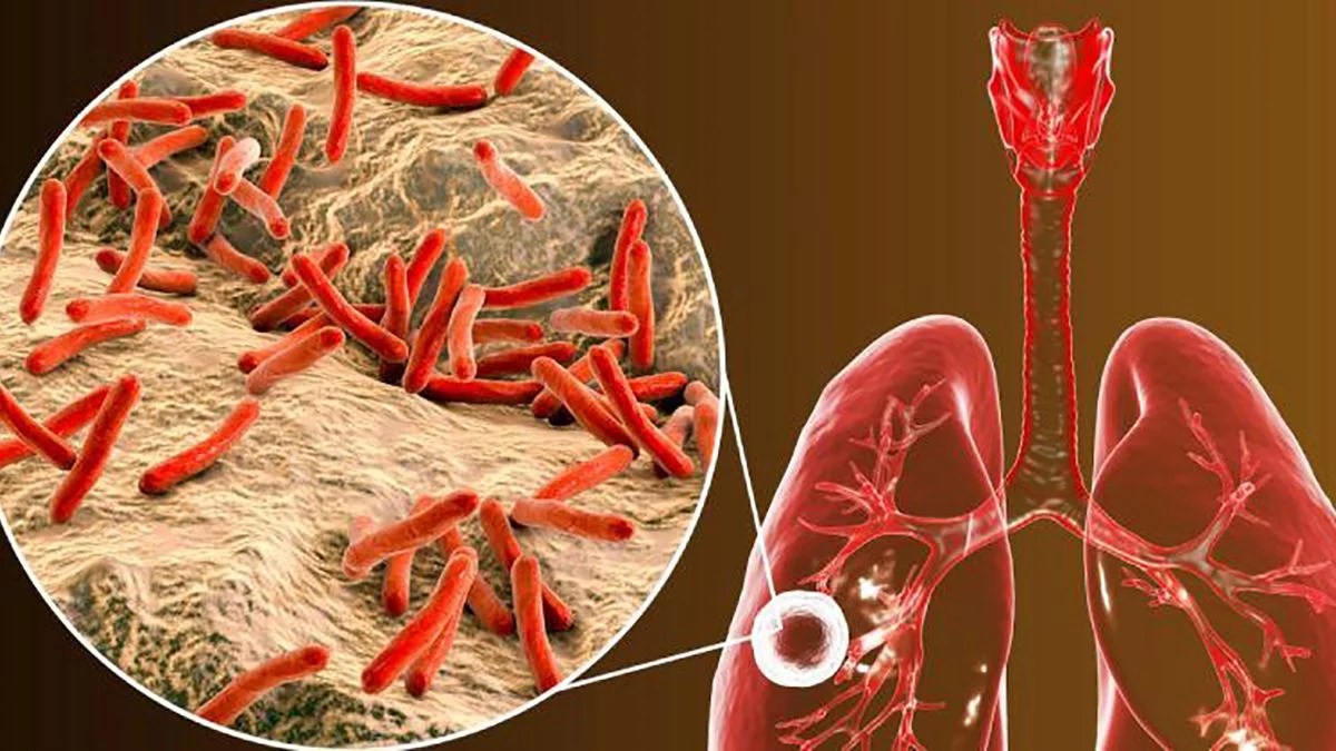 Algeria: Suspected cases of tuberculosis among sub-Saharan migrants