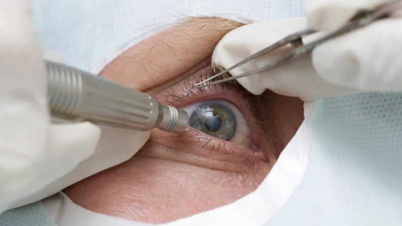 Algeria to Launch Corneal Transplant Program from Deceased Donors
