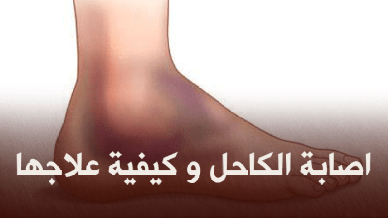 إصابة الكاحل لدى الرياضيين وكيفية علاجها