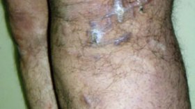 ورم غريب يحرم كمال من الزواج ويدخله عالم البطالة