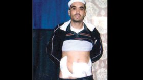 طبيب ينزع الزائدة الدودية لمريض رغما عنه