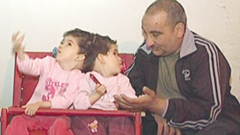 زكاة وسلسبيل توأم “سيامي” بحاجة إلى عملية جراحية قدرها 11 مليار سنتيم فمن يجيب؟