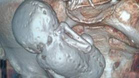 اكتشاف حالة حمل نادرة لعجوز في الـ73 من العمر بسكيكدة