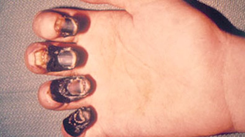 الجزائريون على موعد مع الطاعون في2012