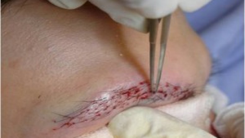 موضة زرع الحواجب تطغى بقوة بحثا عن الكثافة