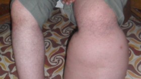 ديدان‭ ‬مسطحة‭ ‬تحول‭ ‬رجالا‭ ‬ونساء‭ ‬لأقدام‭ ‬للفيلة‮ ‬والمصابون‭ ‬يطالبون‭ ‬وزارة‭ ‬الصحة‭ ‬بالاستفادة‭ ‬من‭ ‬مزايا‭ ‬الأمراض‭ ‬المزمنة