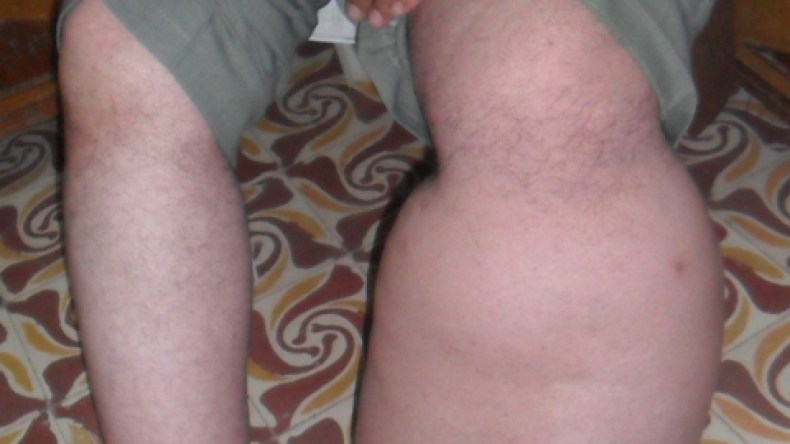 ديدان‭ ‬مسطحة‭ ‬تحول‭ ‬رجالا‭ ‬ونساء‭ ‬لأقدام‭ ‬للفيلة‮ ‬والمصابون‭ ‬يطالبون‭ ‬وزارة‭ ‬الصحة‭ ‬بالاستفادة‭ ‬من‭ ‬مزايا‭ ‬الأمراض‭ ‬المزمنة