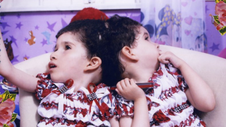 من يضمن جراحة فصل ناجحة للتوأم السيامي زكاة وسلسبيل؟