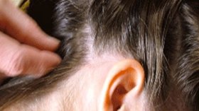 القمل يجتاح المدارس وروضات الأطفال