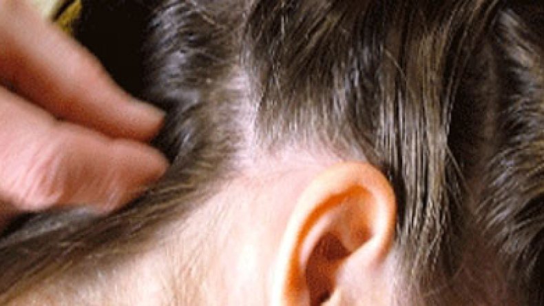 القمل يجتاح المدارس وروضات الأطفال