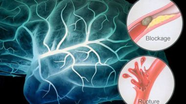 Algérie: 50.000 nouveaux cas d’AVC recensés annuellement