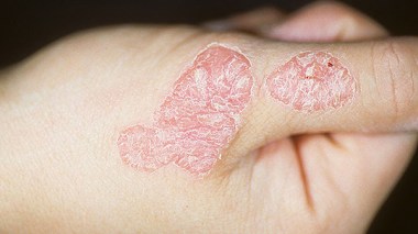 Quand le Psoriasis alourdit le quotidien du malade algérien