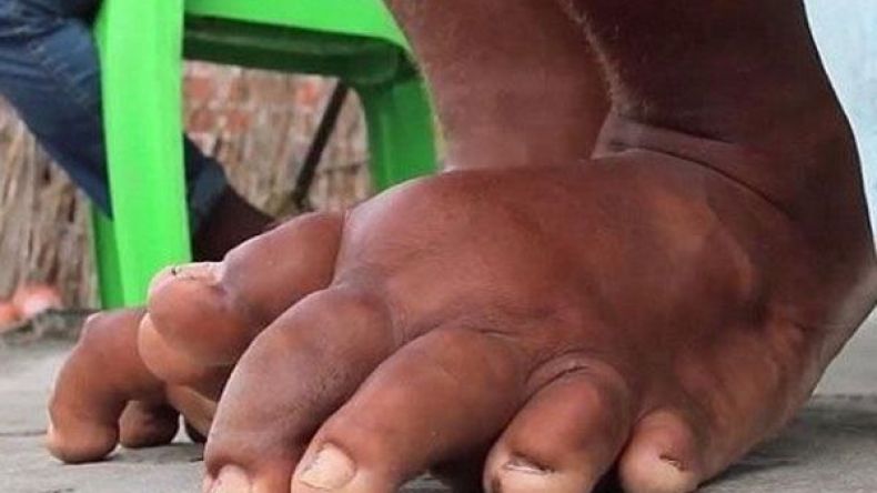 150جزائري مصابون بمرض “الآكروميغالي”