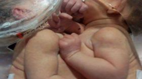 ريان وجهاد ولدتا ملتصقتين وعائلتهما تناشد وزير الصحة