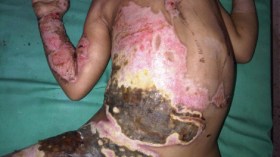 أطفال يفقدون “وجوههم” وأطرافهم وأعضاءهم الجنسية