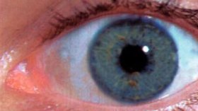 داء مجهول يصيب العينين ينتشر في أرجاء خنشلة