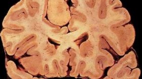 نجاح أول عملية لاستئصال ورم بالمخ بمؤسسة استشفائية عمومية