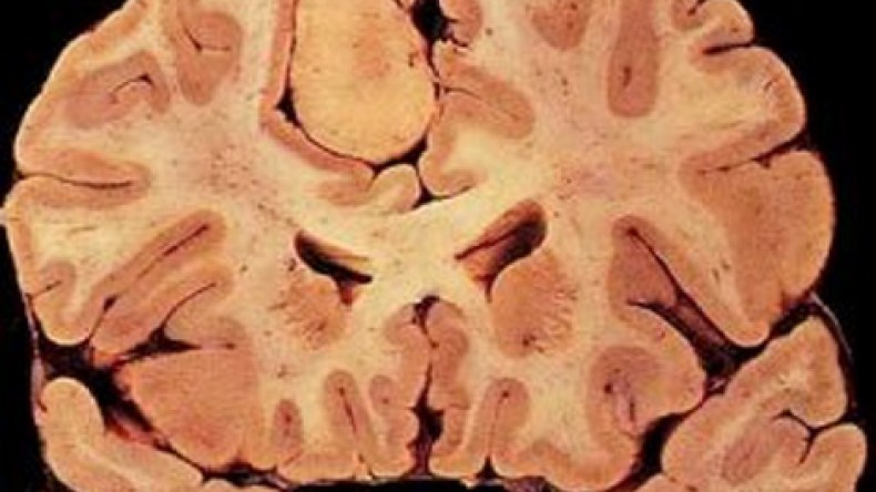 نجاح أول عملية لاستئصال ورم بالمخ بمؤسسة استشفائية عمومية