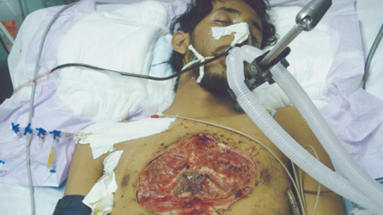 إسرائيل تستخدم سلاحا خطيرا يتسبب في تحلّل أجساد المصابين