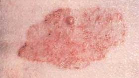 كشف عن سببين للإصابة بسرطان الرأس والعنق