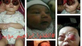 هذا ما حدث للرضيع إبراهيم بعد استئصال عينيه؟!