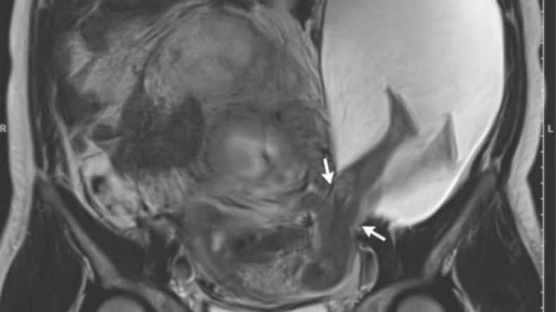 جنين تخرج قدماه من الرحم قبل موعد الولادة بأسابيع!