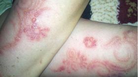 هذا ما فعلته الحناء السوداء بالفتيات؟!