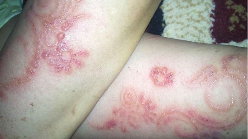 هذا ما فعلته الحناء السوداء بالفتيات؟!