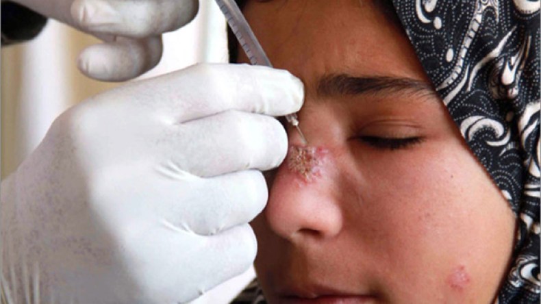 10 حالات إصابة بالليشمانيا الجلدية أسبوعيا بالوادي