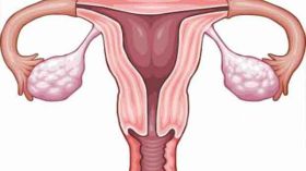 متلازمة فرط تحفيز المبيض