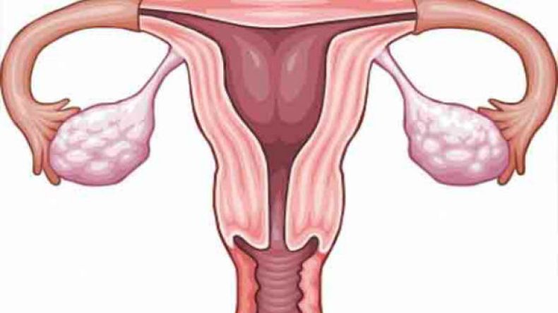 متلازمة فرط تحفيز المبيض