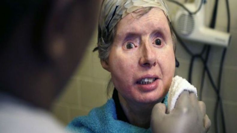 عملية زرع وجه فاشلة لأمريكية شوّهها قرد