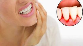 دراسة أمريكية: أمراض اللثة تزيد خطر الإصابة بالسرطان لدى النساء