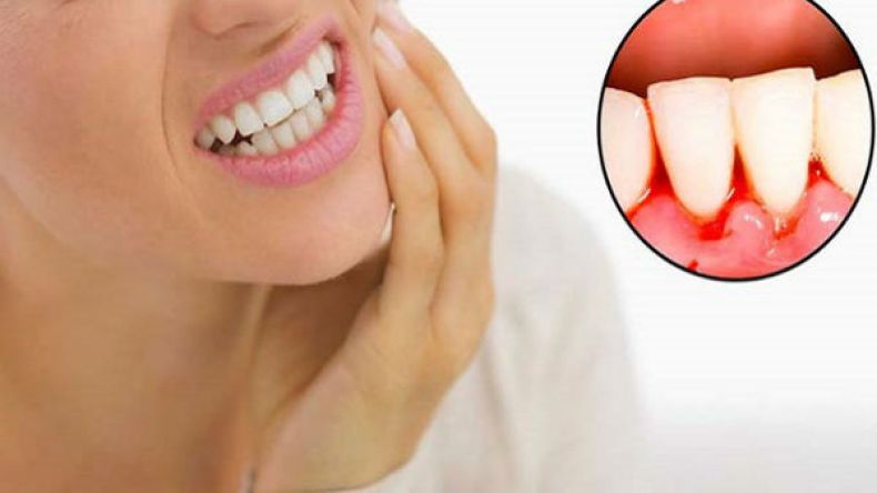 دراسة أمريكية: أمراض اللثة تزيد خطر الإصابة بالسرطان لدى النساء