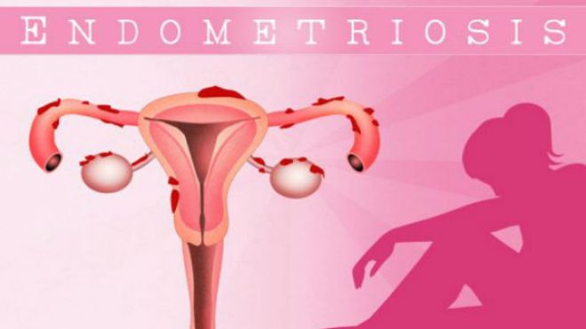 صحِّحي معلوماتكِ عن بطانة الرحم المهاجرة