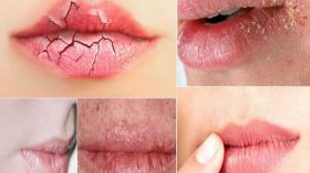 إليك أنجع الطرق لعلاج تشقق الشفاه؟!