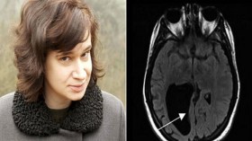 أمريكية تعيش بثقب كبير في الدماغ
