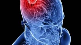 الأورام الدماغية الحميدة.. أعراضها وعلاجها