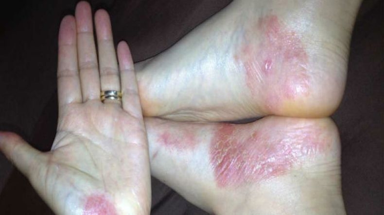 الصدفية ليست مجرد مشكلة جلدية