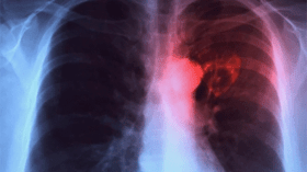 إصابة 5 تلاميذ بداء “السل” في ثانوية بسطيف