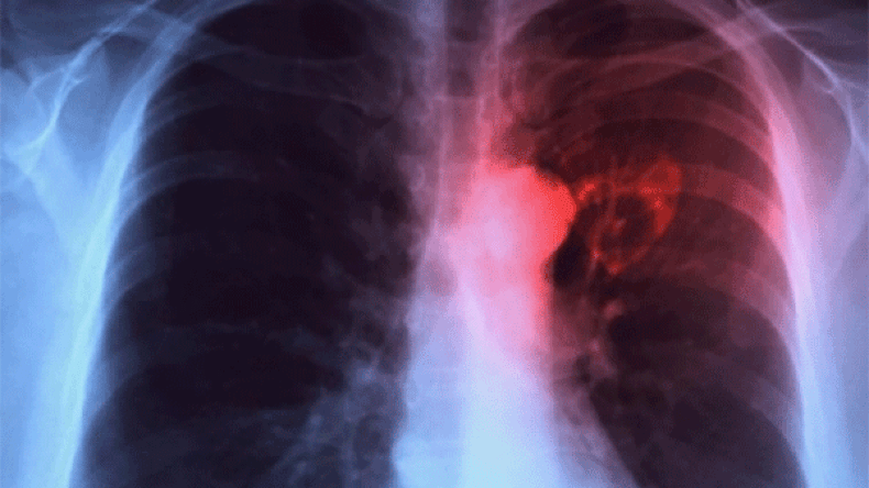 إصابة 5 تلاميذ بداء “السل” في ثانوية بسطيف