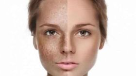 بهذه الطريقة.. تخلصي من الكلف في 10 أيام؟