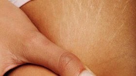 هكذا تعالجين تمدد البشرة بطرق طبيعية؟!