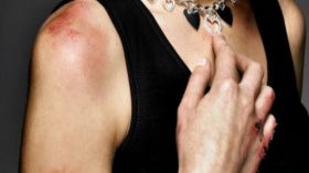 تونسيات ظهرن بآثار تعذيب على أجسادهن.. من السبب؟