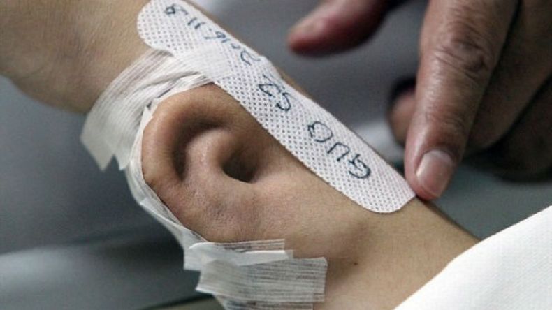 أطباء صينيون يزرعون أذناً في ذراع مريض.. نعم ذراعه!