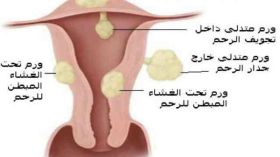 ألياف الرحم.. مشكلة تؤرق النساء