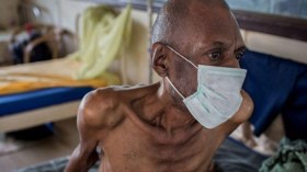 الصحة العالمية: السل ينافس الإيدز كسبب رئيسي للوفيات في العالم