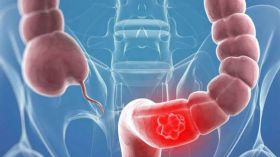 القولون العصبي والحمل