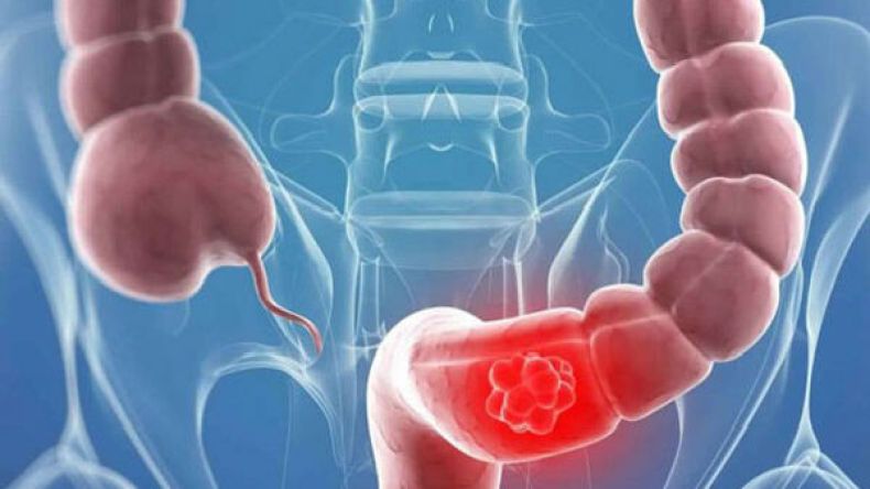 القولون العصبي والحمل