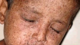 اعتماد أول جمعية للتكفل بأطفال القمر بالجزائر